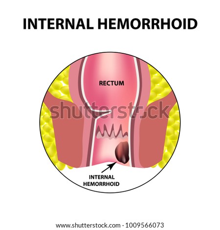 Hemorrhoids internal. Rectum structure. Intestines. colon. Internal hemorrhoidal node. Infographics. Vector illustration on isolated background.