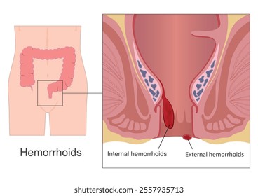 Hemorrhoids internal the rectum are usually painless but tend to bleed. Hemorrhoids external the rectum may cause pain. Hemorrhoids also called piles are swollen veins in the anus and lower rectum. 