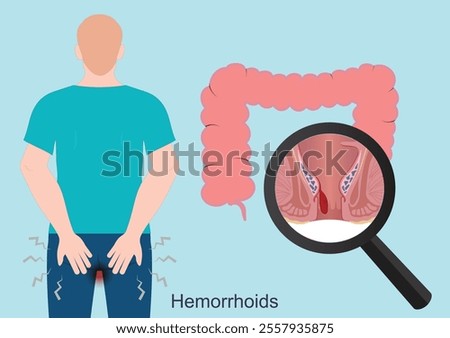 Hemorrhoids or piles are common irritations around the rectum and can be extremely painful.The veins around the anus stretch due to increased pressure in the lower rectum, medical healthcare vector