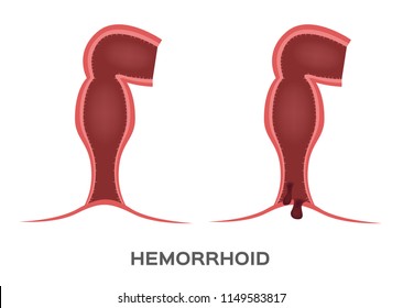 Hemorrhoids stage vector. ass and anus