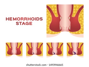 Hemorrhoids stage vector on white background
