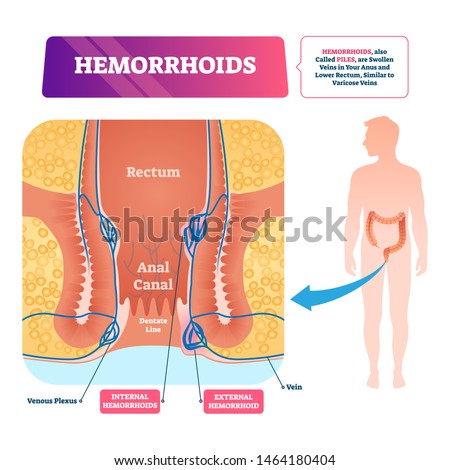 Hemorrhoids vector illustration. Labeled anatomical vascular piles scheme. Diagram with swollen veins in anus and lower rectum illness. Educational infographic with painful disease, digestive problem.