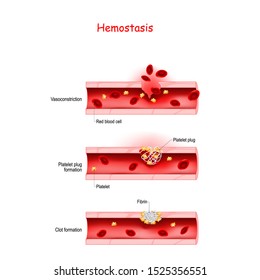 Hemostasis. Basic Steps Of Wound Healing Process (Platelet Plug Formation, And Vasoconstriction). Blood Vessel Injury And Inflammation. Vector Diagram For Medical, Educational And Scientific Use.