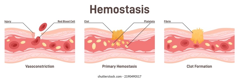 Hemostasis. Wound Healing Process Stages, Vasoconstriction And Clot Formation. Blood Vessel Injury And Inflammation. Flat Vector Illustration