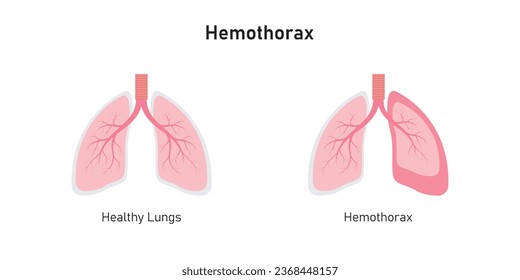 Hemothorax Lungenkrankheit Konzept Design. Vektorgrafik.