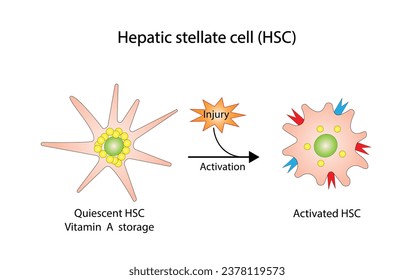 Leberstellatzelle, HSC. Ruhige HSC-Vitamin-A-Lagerung. Aktivierter HSC, Ablagerung von Kollagen. Leberfibrose. Vektorgrafik.