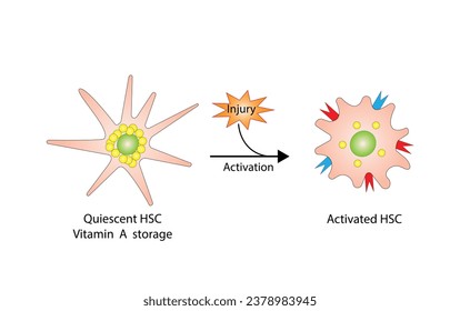 Leberstellatzelle, HSC. Ruhige HSC-Vitamin-A-Lagerung. Aktivierter HSC, Ablagerung von Kollagen. Leberfibrose. Vektorgrafik.