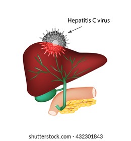 Hepatitis C. The introduction of the hepatitis C virus in the liver. The structure of the digestive system. Gallbladder. Pancreas. Bile ducts. Duodenum. World Hepatitis Day. Vector illustration.