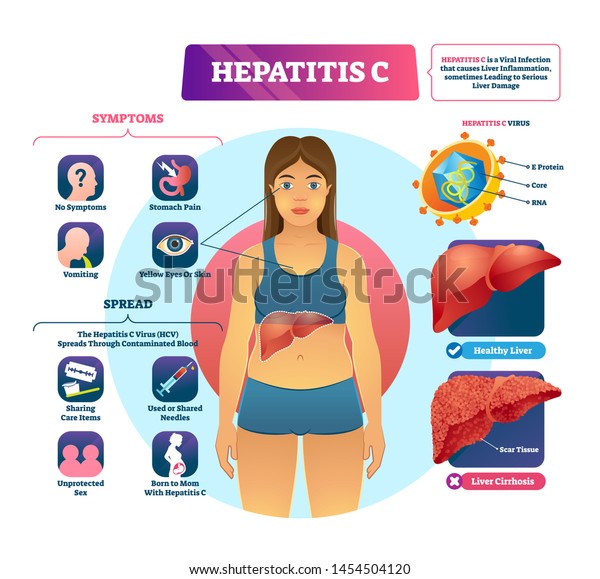 Hepatitis C vector illustration. Labeled viral\
infection explanation scheme. Liver inflammation with scar tissues\
and cirrhosis. Virus disease symptoms and spreads infographic.\
Yellow skin\
diagnosis.