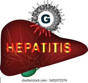 Hepatitis G. World Hepatitis Day. Infographics. Vector illustration on isolated background.