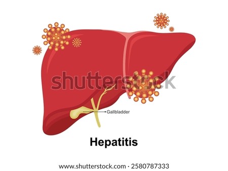 Hepatitis is an inflammation of the liver. The condition can be self-limiting or can progress to fibrosis (scarring), cirrhosis or liver cancer. medical health care, vector illustration.