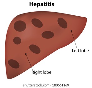 Hepatitis Labeled Diagram