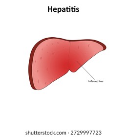 Hepatitis liver disease vector illustration