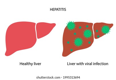 Logo de la hepatitis. Inflamación hepática debida a un concepto de infección viral. Virus y dolor en órganos internos humanos. Enfermedad del sistema digestivo ilustración vectorial plana