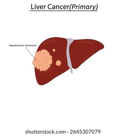 Ilustración vectorial por carcinoma hepatocelular (CHC)