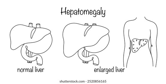 Hepatomegal. Ein pathologischer Zustand, der durch unnatürliche Vergrößerung und Anzeichen diffuser Veränderungen in der Leber gekennzeichnet ist. Gesunde Leber und vergrößerte Leber. Medizinischer Vektor.