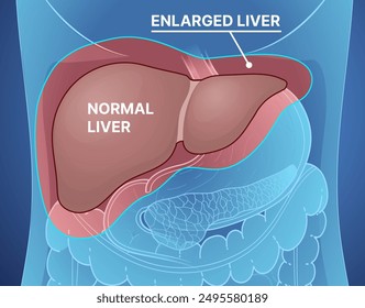 Hepatomegaly. Normal liver, enlarged liver. Liver disease. Healthcare illustration. Vector illustration.