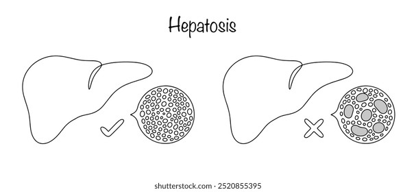 Hepatosis. Metabolic disorders in liver cells (hepatocytes) and the development of dystrophic changes in liver cells. Healthy liver and liver with hepatosis. Simple vector illustration.