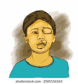 Angioedema hereditario AEH. Un ataque de AEH puede resultar en hinchazón rápida de las manos, pies, extremidades, cara, tracto intestinal