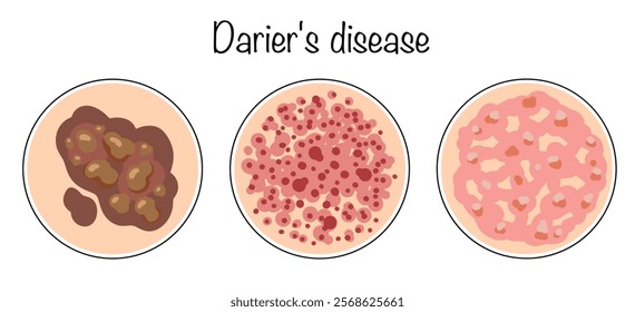 A hereditary autosomal dominant disease, which is characterized by pathological keratinization and rashes on seborrheic areas of the skin. Drawn variants of the manifestation of the disease.