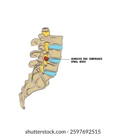 Hernia in the spine, discs pressing on nerves.