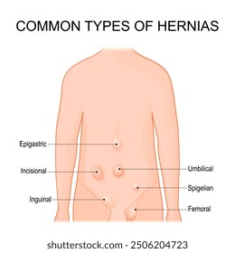 Hernia types. Common sites for hernias. Schematic diagram. Detailed vector illustration