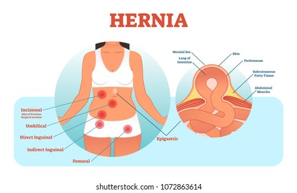 Hernie abdominala