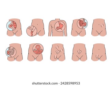 Hernias line icons set. Vector isolated element. Editable stroke.