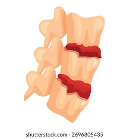 Herniated disc causing spinal cord damage, medical illustration showing injury