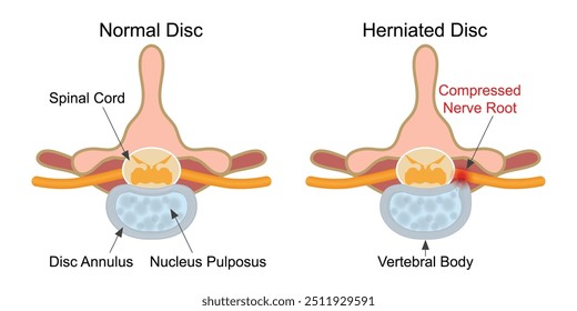 O disco herniado é um fragmento do núcleo do disco que é empurrado para fora do anel, para o canal espinhal através de uma ruptura ou ruptura no anel.