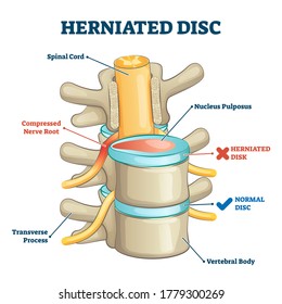 Herniated disc injury 3D side view on spinal bone skeleton vector illustration. Medical condition with back trauma pain and nerve root compression by nucleus pulposus. Problematic example comparison.