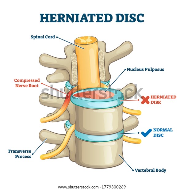Herniated disc injury 3D side view on spinal\
bone skeleton vector illustration. Medical condition with back\
trauma pain and nerve root compression by nucleus pulposus.\
Problematic example\
comparison.
