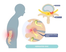 Herniated Disc Injury To The Cushioning And Connective Tissue Between Vertebrae Disk Bone Back Annulus Nucleus Bulged Older Cord Muscle Weakness Neck  Cauda Equina