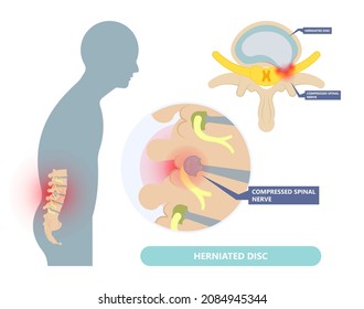 Herniated disc injury to the cushioning and connective tissue between vertebrae disk bone back annulus nucleus bulged older cord muscle weakness neck  cauda equina