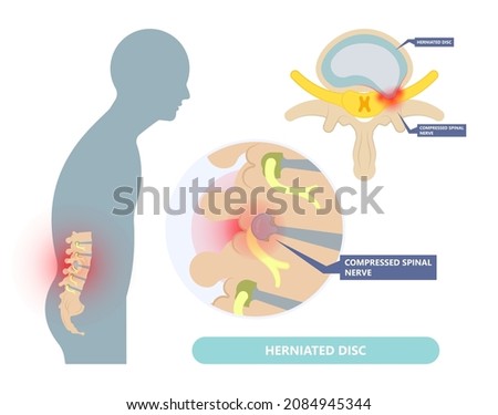 Herniated disc injury to the cushioning and connective tissue between vertebrae disk bone back annulus nucleus bulged older cord muscle weakness neck  cauda equina Stock photo © 