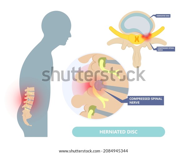 Herniated disc injury to the\
cushioning and connective tissue between vertebrae disk bone back\
annulus nucleus bulged older cord muscle weakness neck  cauda\
equina