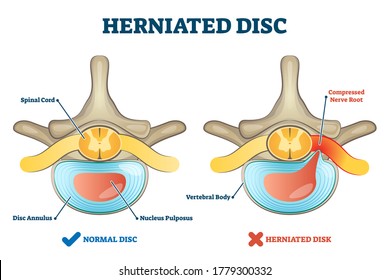 Herniated disc injury as labeled spinal pain explanation vector illustration. Medical condition with back bone trauma and nerve root compression by nucleus pulposus. Problematic example comparison.