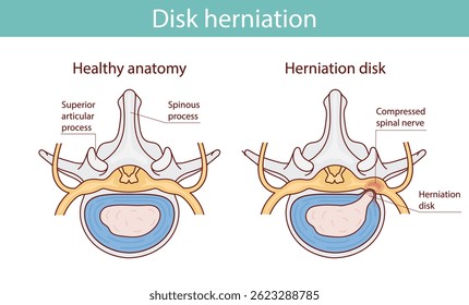 Lesão de disco herniada como ilustração de vetor de explicação de dor na coluna rotulada
