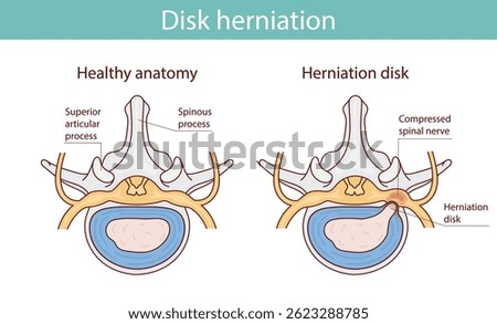 Herniated disc injury as labeled spinal pain explanation vector illustration