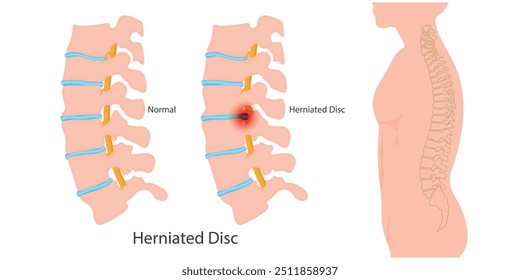 O disco herniado também é conhecido como disco escorregadio, rompido ou abaulado. É uma das causas mais comuns de dor no pescoço, nas costas e nas pernas.Ortopedia central, saúde e ilustração médica vetorial.