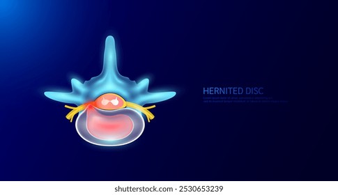 Herniated disc that make back and neck pain. Top view spinal nerve cord yellow. Vertebral anatomy and disc bone human organ on dark blue background. Medical diagnosis concept. Banner vector EPS10.