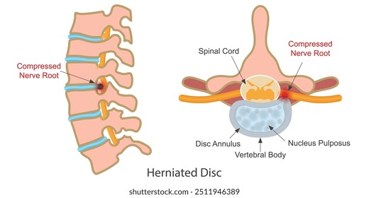 La hernia discal es una afección que puede ocurrir en cualquier parte a lo largo de la columna vertebral, protrusión, protrusión o ruptura discal.Es una de las causas más comunes de dolor en la parte baja de la espalda, dolor en las piernas o ciática.Salud médica