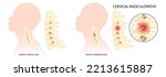 Herniation bone disk of neck and thoracic outlet syndrome root injury pain damage spine canal degeneration traumatic spurs painful Spinal cord pinched nerves Tingling Numbness hand