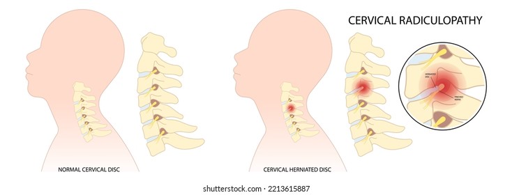Herniation bone disk of neck and thoracic outlet syndrome root injury pain damage spine canal degeneration traumatic spurs painful Spinal cord pinched nerves Tingling Numbness hand