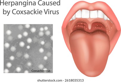Herpangina Caused by Coxsackievirus. Medical Illustration of Coxsackievirus Infection in Throat and Mouth. Oral Herpangina Ulcers from Coxsackie Virus