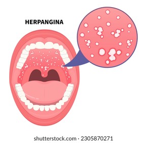 Herpangina hand foot mouth throat disease herpes strep stomatitis canker sore a coxsackie virus infection enteroviruses