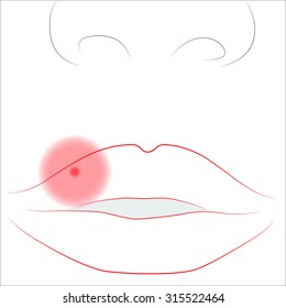 Herpes