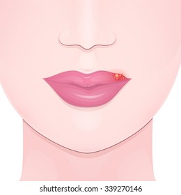 herpes, close-up lips with cold sore, upper lip inflammation and bubbles