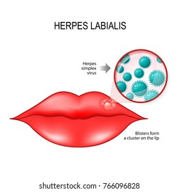 Herpes labialis (blisters) on the lip. cause is herpes simplex virus (under a magnifying glass). Vector diagram for medical use