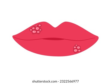 Herpes on female lips in flat design on white background.